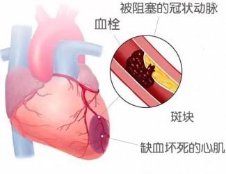 血栓的形成原因及后果，如何預(yù)防血栓導(dǎo)致的疾病