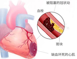 心臟病該怎么辦，且看臨床治療醫(yī)案一則